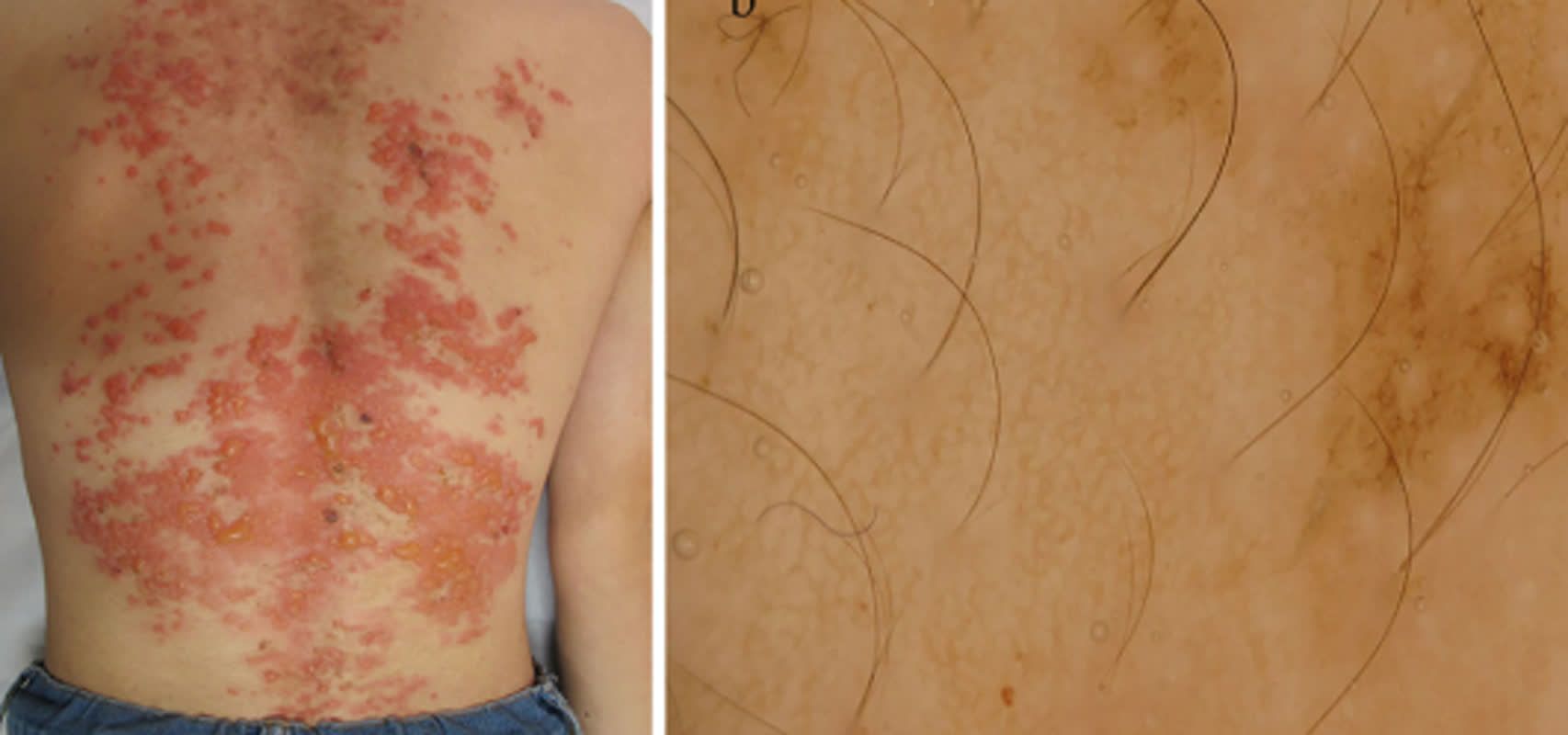 색소성양진 원인 및 증상 케톤증 으로 인해 발생하는 가렵고 붉은 발진 | 건강한 삶을 리뷰하는 Heeee